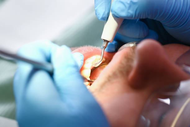 Best Emergency Root Canal Treatment in Elfers, FL